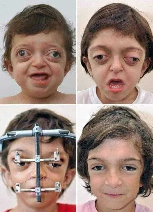 Crouzon Syndrome.webp