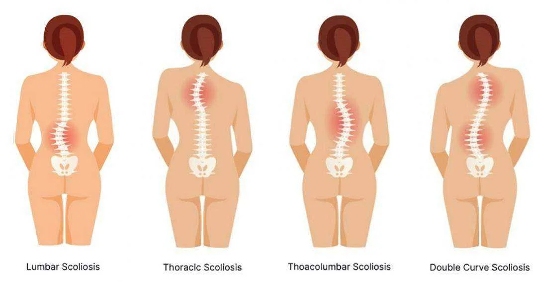 Types of Scolio.jpg