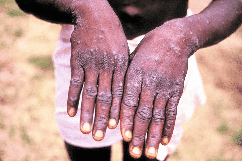 1,284 suspected cases of monkeypox in 2022