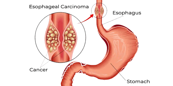 GERD-esophogeal-cancer-diagram.png
