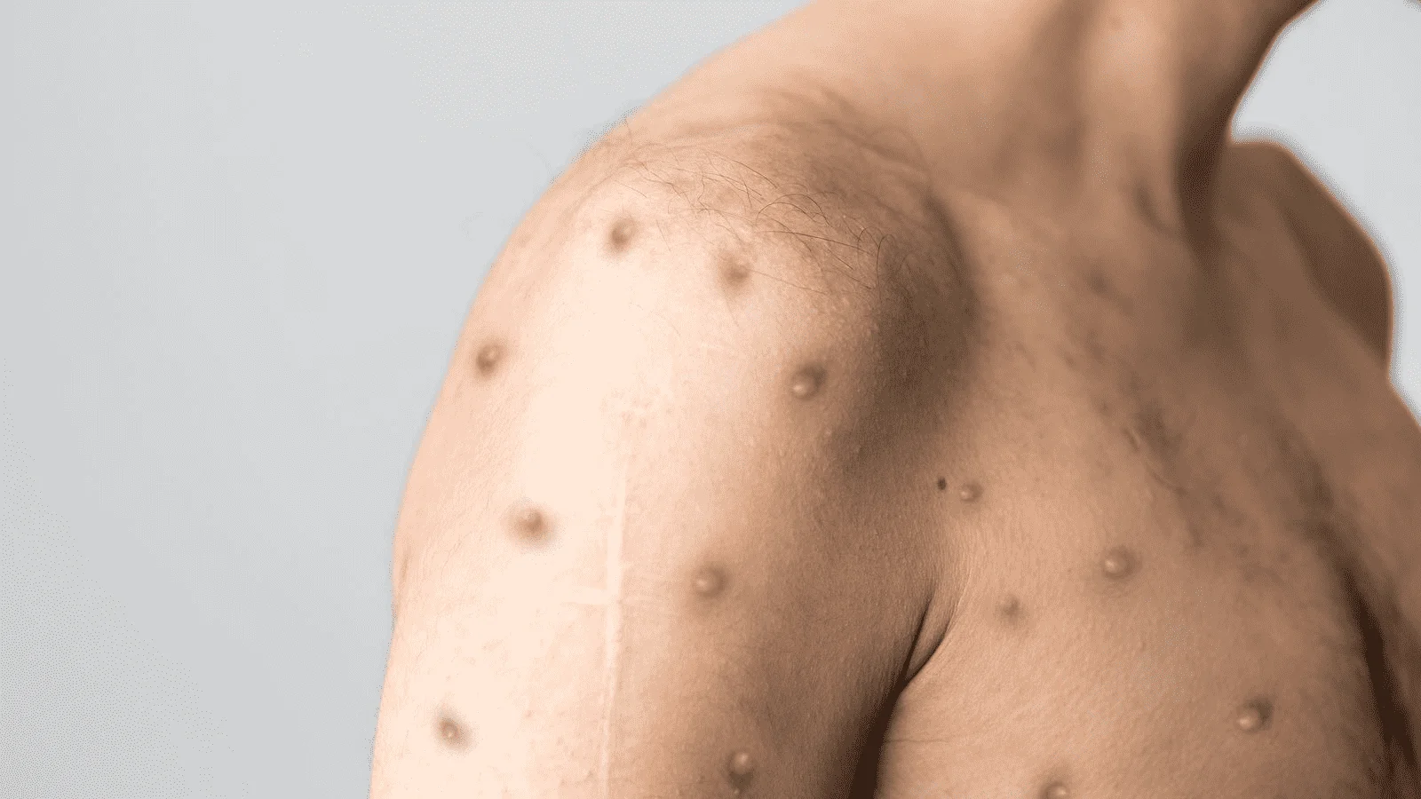 BREAKING NEWS: W.H.O. declared global health | Monkey Pox