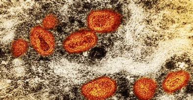 95% ng monkeypox cases sa buong mundo, naihawa sa sexual contact