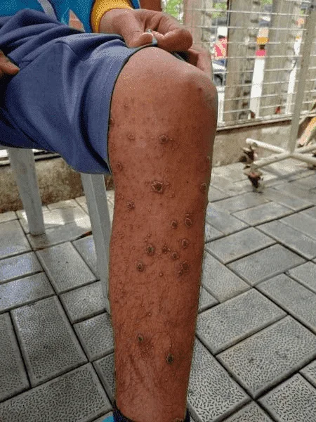 1st Confirmed monkey pox case in  iloilo.Mag-ingat po tayo!