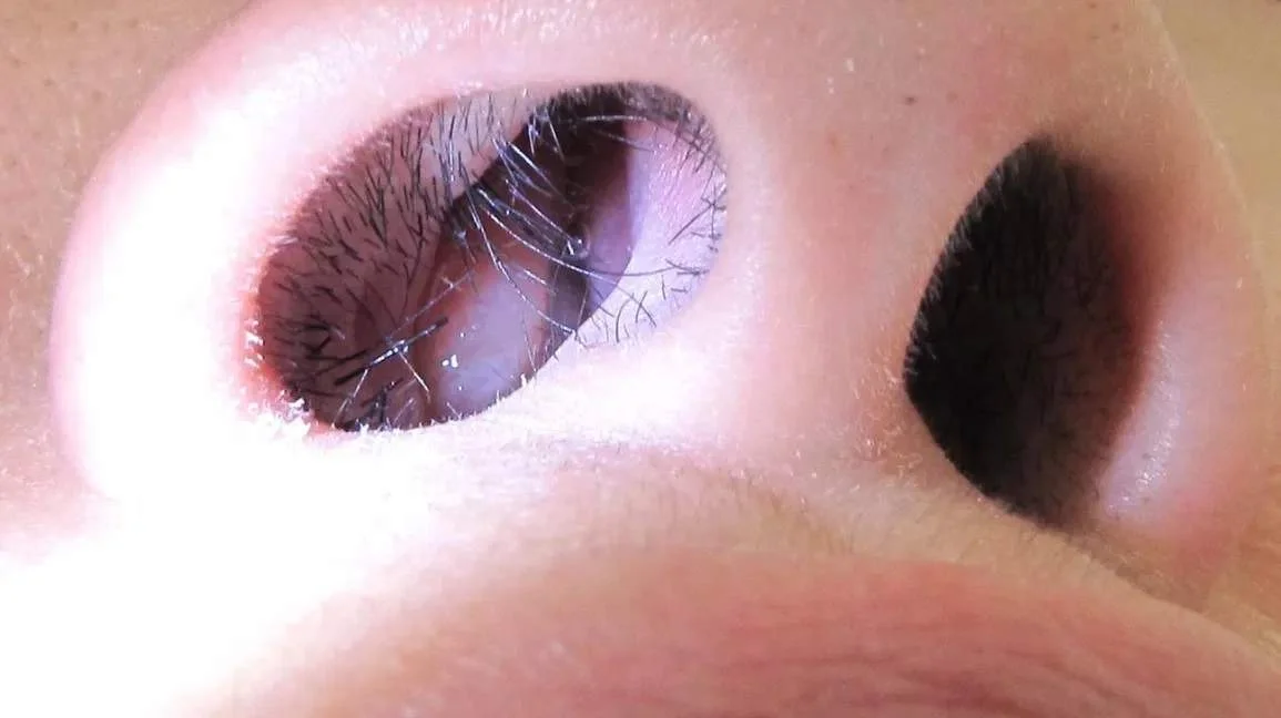 1296x728_Polype_Nasal.webp