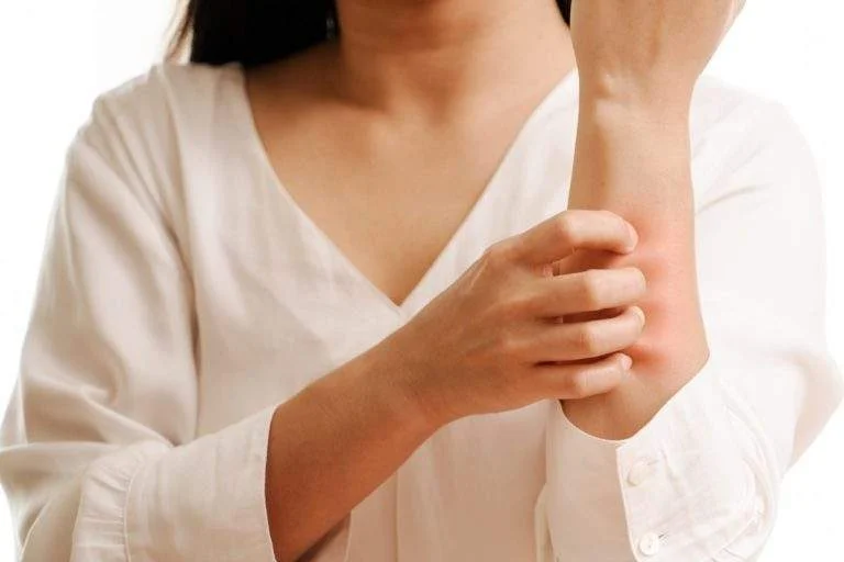 woman-scratching-her-arm.webp