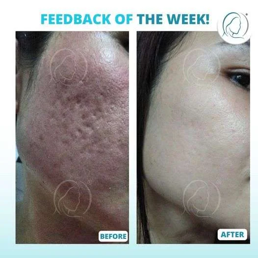 Derma Roller.webp